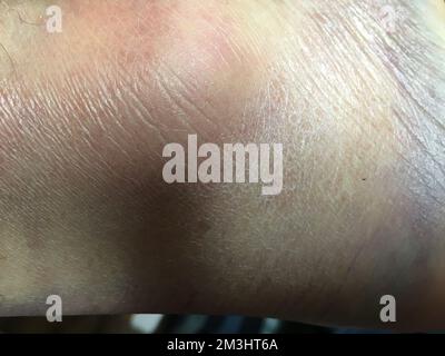 Sprained Skin Coloured bruises, sprained, dislocated ankle. Abstract shades, skin ...