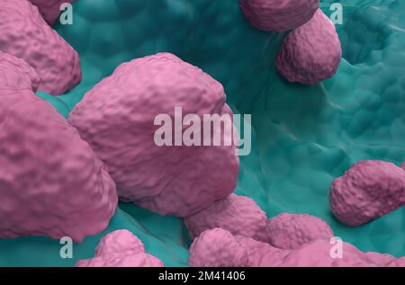 Non Small Cell Lung Cancer (NSCLC) in the lung tissue - isometric view ...