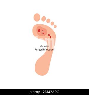 Foot with fungal skin disease Stock Vector