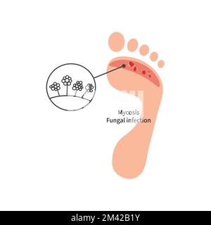 Foot with fungal skin disease Stock Vector