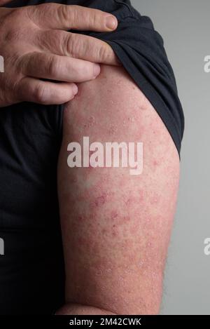 A red rash on the forearm. Erysipelas. Hand afflicted вermatophytosis on skin. Stock Photo