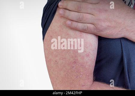 Erysipelas on the hand. A red rash appears on the forearm. Stock Photo
