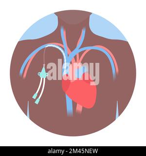 Tunneled central line venous catheter medical diagram Stock Vector