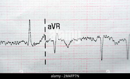 ECG ElectroCardioGraph paper that shows Normal Sinus Rhythm NSR with ...