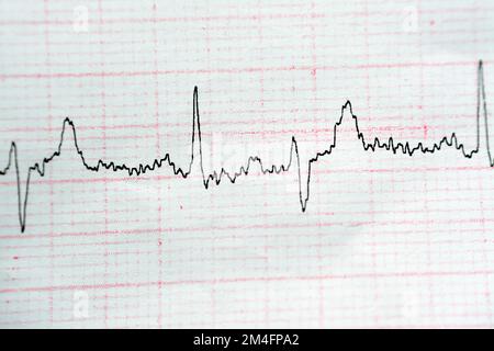 ECG ElectroCardioGraph paper that shows Normal Sinus Rhythm NSR with ...