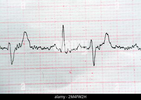 ECG ElectroCardioGraph paper that shows Normal Sinus Rhythm NSR with ...