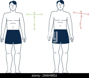Standing man with incorrect spine posture. Spine health, bad body pose ...