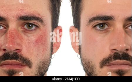 Young man before and after acne treatment on white background. Skin ...