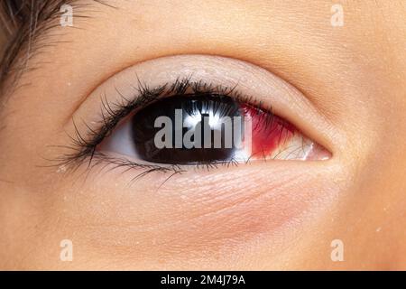 Macro of kid eye with subconjunctival hemorrhage. Blood stain in the eye due to broken capillaries Stock Photo