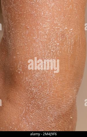 Woman leg with dry skin and dehydration problems. Marked skin exfoliation. Stock Photo