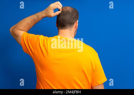 Man with hair loss problem close up, isolated. He alopecia bald hairs on the man's scalp. Human alopecia or hair loss. Scratching his head. Baldness Stock Photo