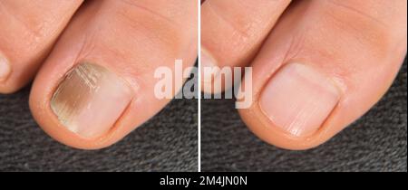 Big toe of a woman with nail affected by onychomycosis, close-up of before and after treatment with antifungal, close-up of before and after treatment Stock Photo