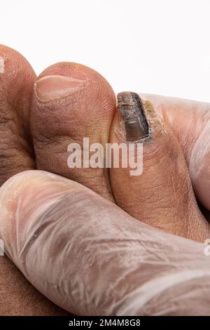 Macro of a toe of an African man suffering from onychomycosis, a fungal infection on the nail that caused hyperkeratosis. Inspection by the dermatolog Stock Photo