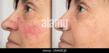 A close-up portrait of before and after a mature woman showing redness on her cheeks. The concept of rosacea. High quality photo Stock Photo