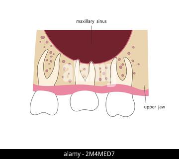 Dental roots in maxillary sinus. Medical illustration in flat style. Stock Vector