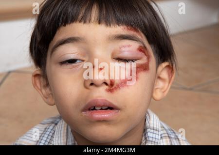 Suffering child with bruises on the face and swollen, bruised eye. Concept of child violence, domestic violence and social services intervention Stock Photo