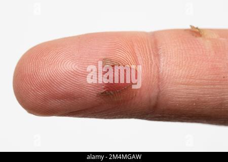 Top macro view peeled skin middle finger heals isolated in white background. Finger with damage already healing concept Stock Photo