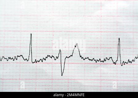 Ecg Electrocardiograph Paper That Shows Normal Sinus Rhythm Nsr With 