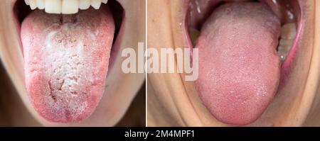 Closeup of woman's tongue sticking out of her mouth. Comparison between a healthy tongue and one with candidiasis and bacterial patina. Hygiene and ha Stock Photo