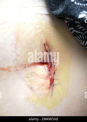 suture after surgery, stitch threads top view on human body's abdomen zone, suture wound after hernia surgery over umbilicus close up Stock Photo