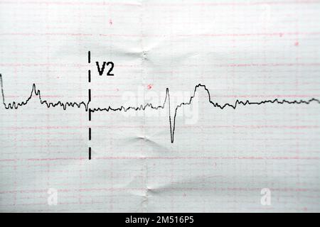 ECG ElectroCardioGraph paper that shows Normal Sinus Rhythm NSR with ...