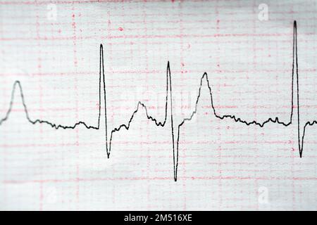 ECG ElectroCardioGraph paper that shows Normal Sinus Rhythm NSR with ...