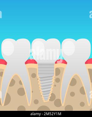 Dental implants, tooth replacement, vector illustration in a cartoon flat style insulated on the topic of dentistry for your projects. Stock Vector