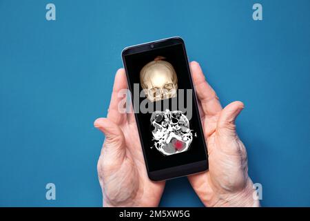computed tomography of the skull with a crack on the forehead after a fall, skull fracture, computed tomography of 3D skull in the phone in the doctor Stock Photo