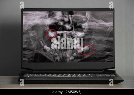 panoramic X-ray of children's teeth of two jaws, orthopantomogram of children's teeth on laptop screens on the table Stock Photo