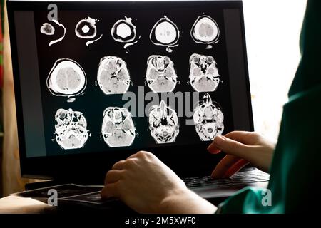 3D computed tomography of the brain with a fracture of the frontal part of the skull after injury on laptop screens on the table on laptop screens at Stock Photo