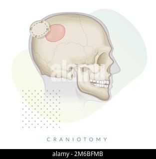 Craniotomy Surgery - Bone Flap Removal - Stock Illustration as EPS 10 ...