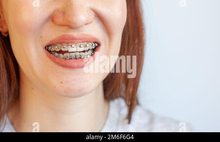 Braces in the smiling mouth of a girl. Smooth teeth from braces. Stock Photo