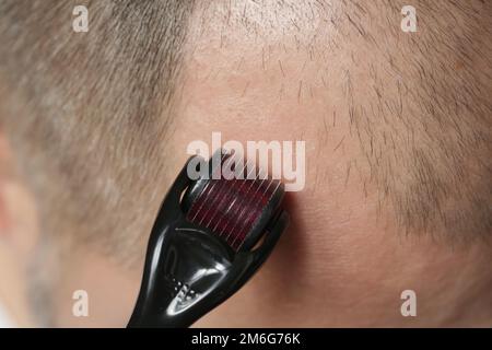 Men using microneedle derma roller on head for stimulating new hair growth. Simple and cheap treatment for alopecia. Stock Photo