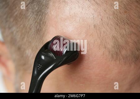 Men using microneedle derma roller on head for stimulating new hair growth. Simple and cheap treatment for alopecia. Stock Photo