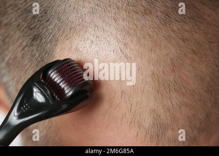 Men using microneedle derma roller on head for stimulating new hair growth. Simple and cheap treatment for alopecia. Stock Photo