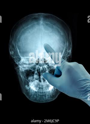 Human skull X-ray front view image film hand in glove Stock Photo