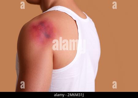 Man with bruise on shoulder against beige background, closeup Stock Photo