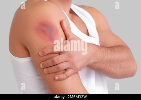 Man with bruise on shoulder against light background, closeup Stock Photo