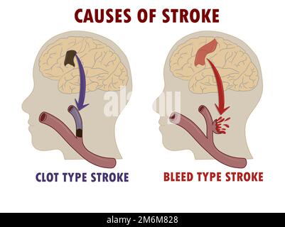 Cause of stroke: comparison of hemorrhagic and ischemic stroke Stock Photo