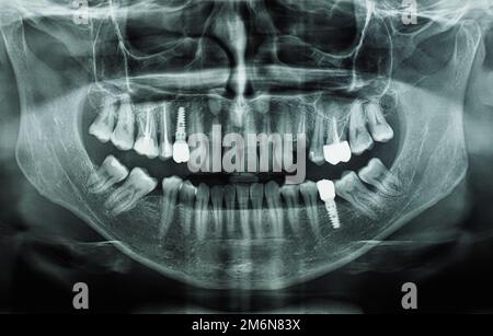 Orthopantomogram Single Panoramic Image Radiograph Of The Mandible ...