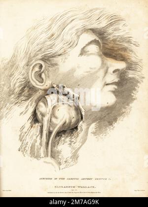 Dissection of a fatal tumor in the neck of a young woman. The fast-growing cancer suffocated her in a month. Elizabeth Wallace, 24-year-old woman 'flesh cadie,' a meat porter in a butcher market. Aneurism of the carotid artery, Sketch 1. Copperplate engraving by Edward Mitchell after an illustration by John Bell from his own Principles of Surgery, as they Relate to Wounds, Ulcers and Fistulas, Longman,  Hurst, Rees, Orme and Brown, London, 1815. Stock Photo