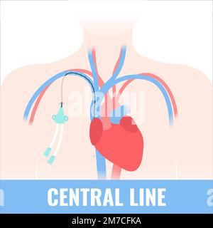 Tunneled central line venous catheter medical diagram Stock Vector