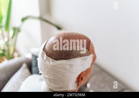 After hair transplantation surgical technique that moves hair follicles. Young bald man in bandage with hair loss problems Stock Photo