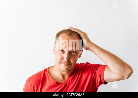 Before hair transplantation. Young bald man with hair loss problems holding his head Stock Photo