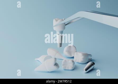 3D rendering Dental implantation concept. Human teeth or dentures tools. Stock Photo