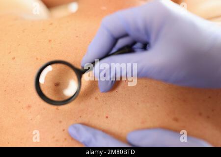 Gloved doctor dermatologist with magnifying glass examines skin of patient. Stock Photo