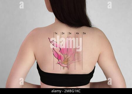 Laser Tattoo Removal On Woman's Back Against White Background Stock Photo