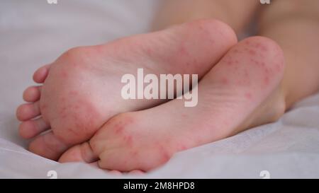 Eczema is an irritation caused by an allergic lesion of skin of feet in child Stock Photo