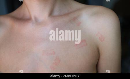Red allergic spots rash on female body. Erythema causes symptoms of the ...