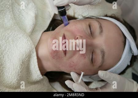 Mesotherapy. Woman having dermapen facial treatment. Micro needle cosmetic treatment at dermatologist. Stock Photo